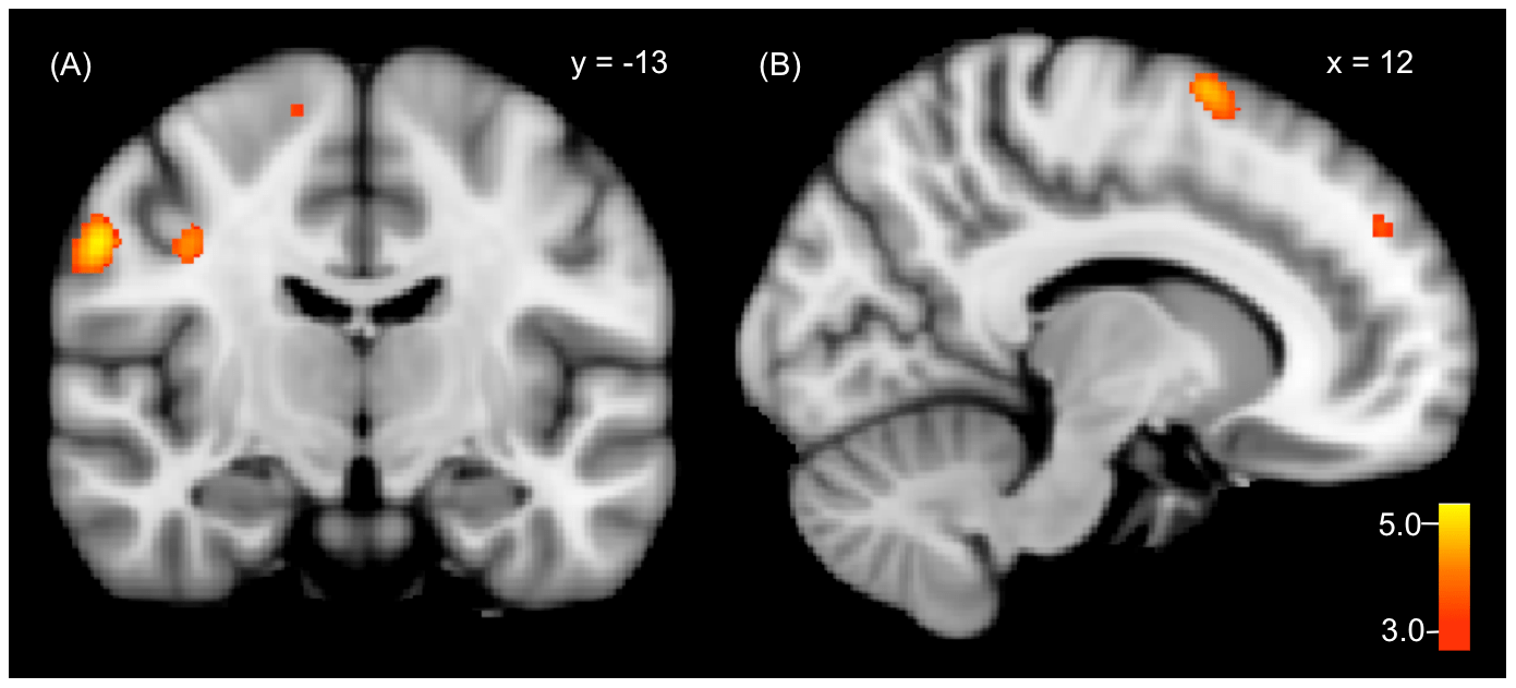 Dissociative_identity_disorder_neuroscience_brain_imaging.png