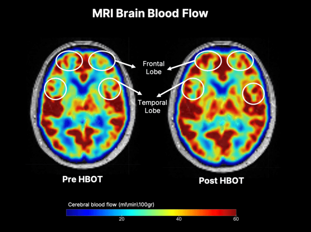 MRI_Brain_Blood_Flow.png