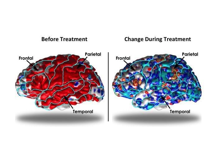 Study-shows-brain-structure-changes-during-depression.jpg