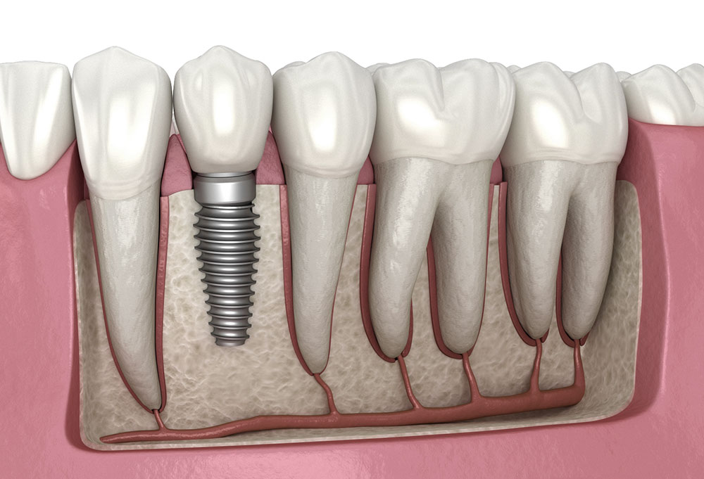The_Amazing_Benefits_of_Dental_Implants.jpg