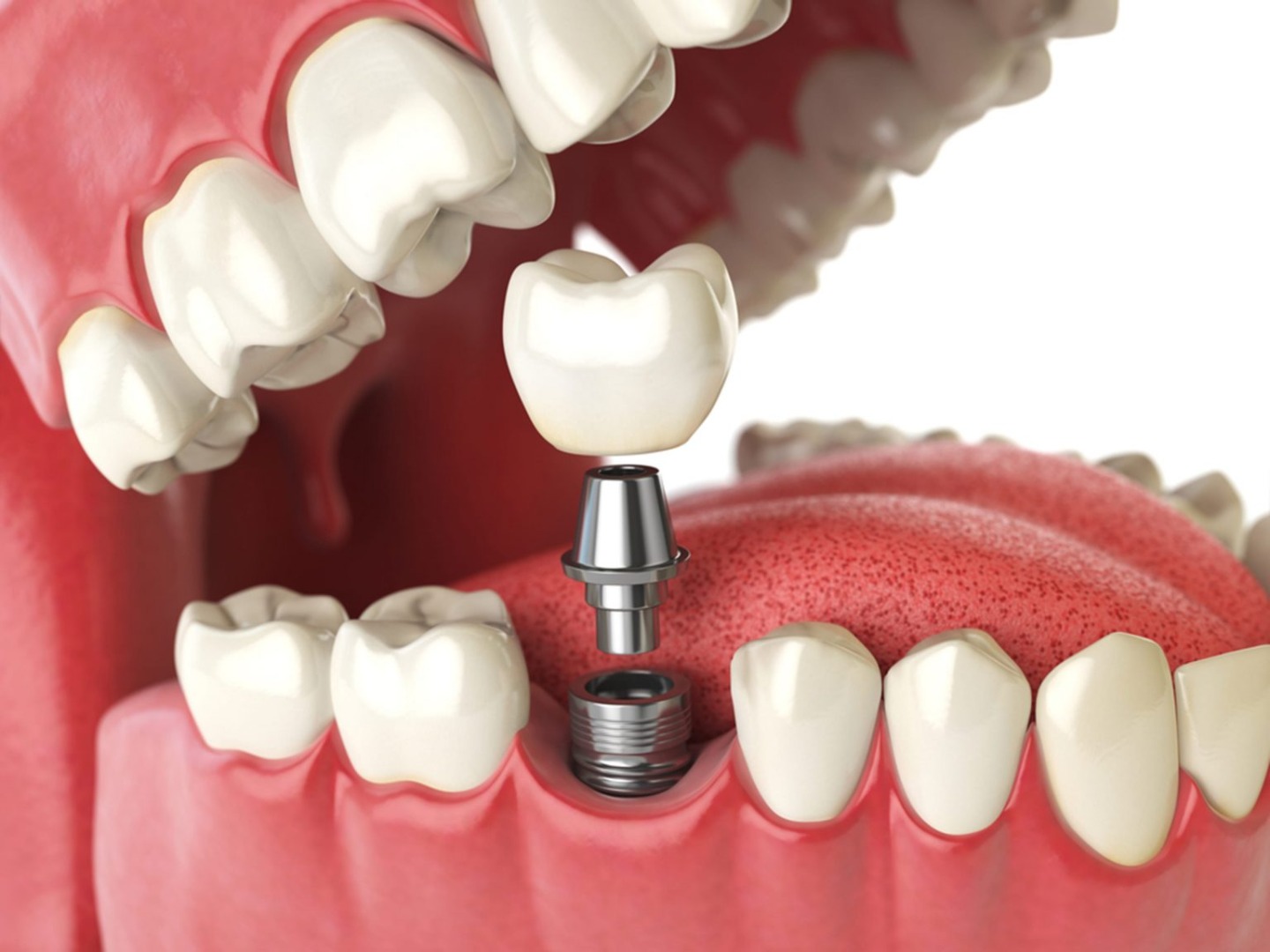 Why_Dental_Implants.jpg