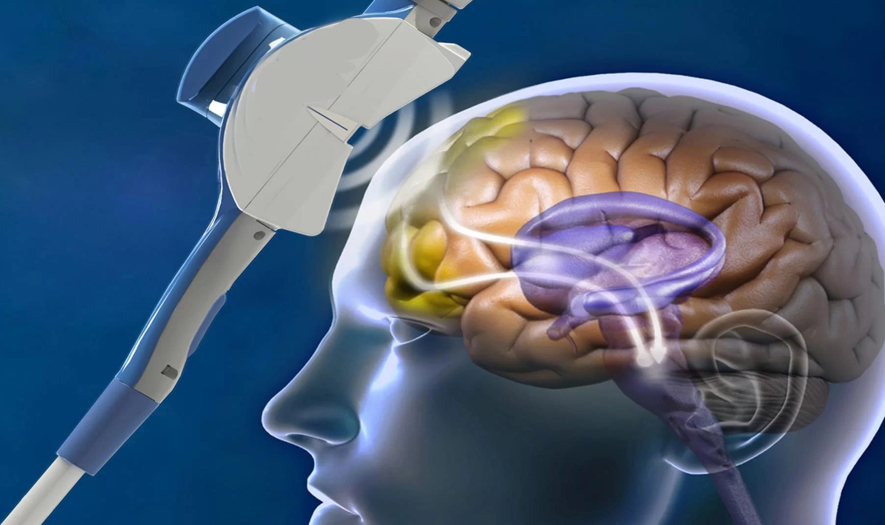What Is Transcranial Magnetic Stimulation And How It's Useful