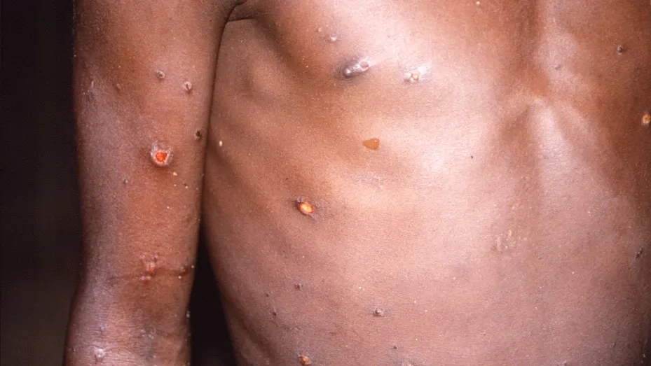 monkeypox symptoms - photo #12
