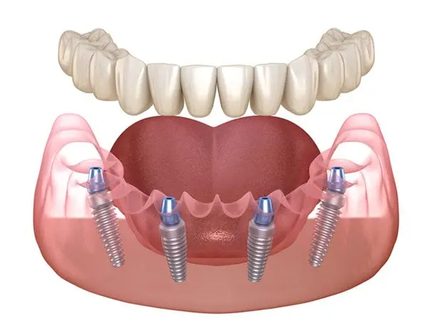 All_on_4_Dental_Implants.jpeg