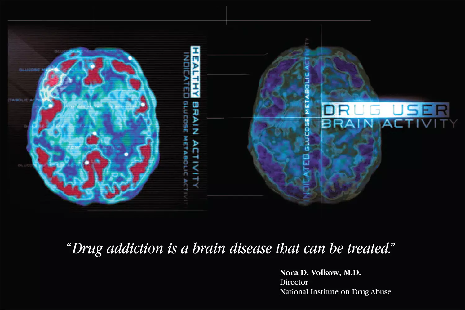 Drug_Addiction_Brain_Disease.jpeg